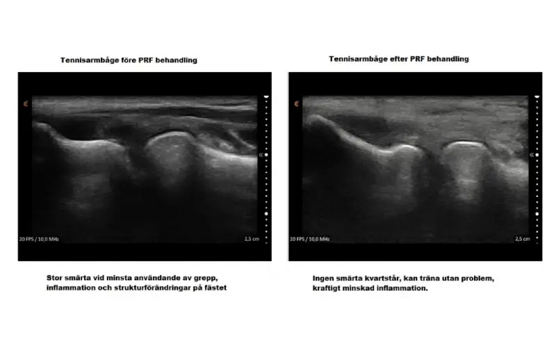 prp behandling stockholm