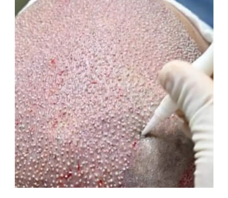 Hair Transplant in Istanbul 