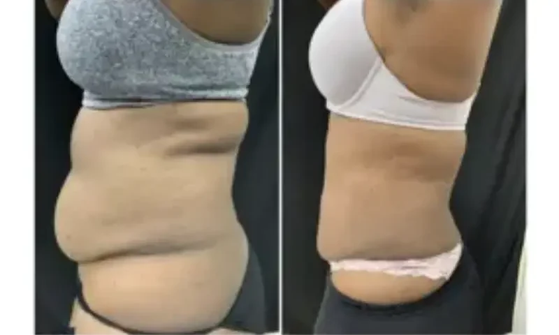 cool sculpting cost stomach