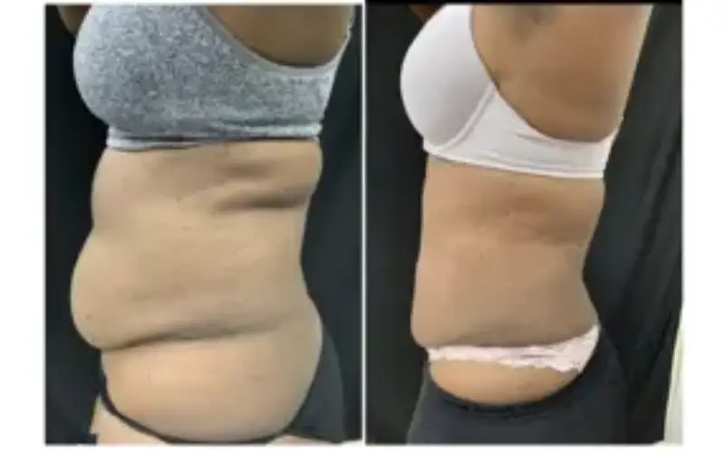 cool sculpting cost stomach