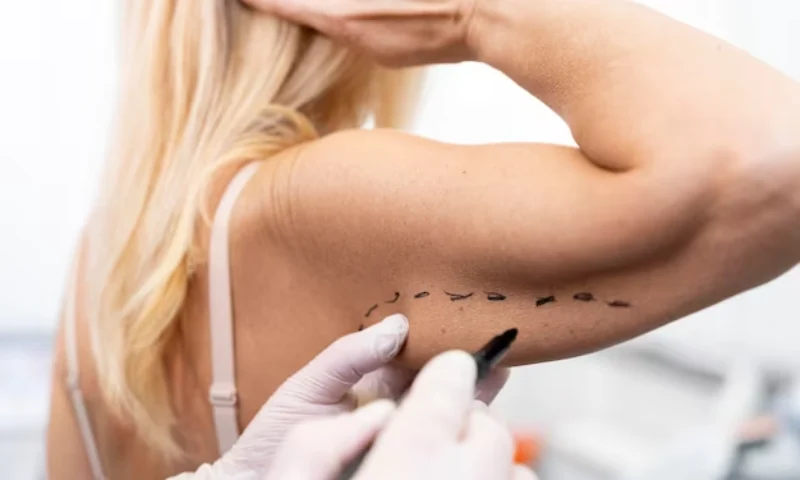 liposuction Washington DC