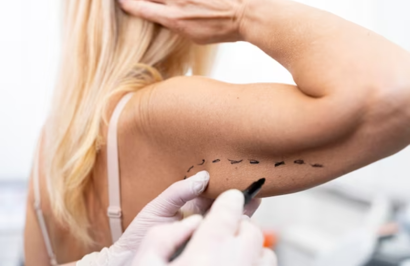 liposuction Washington DC