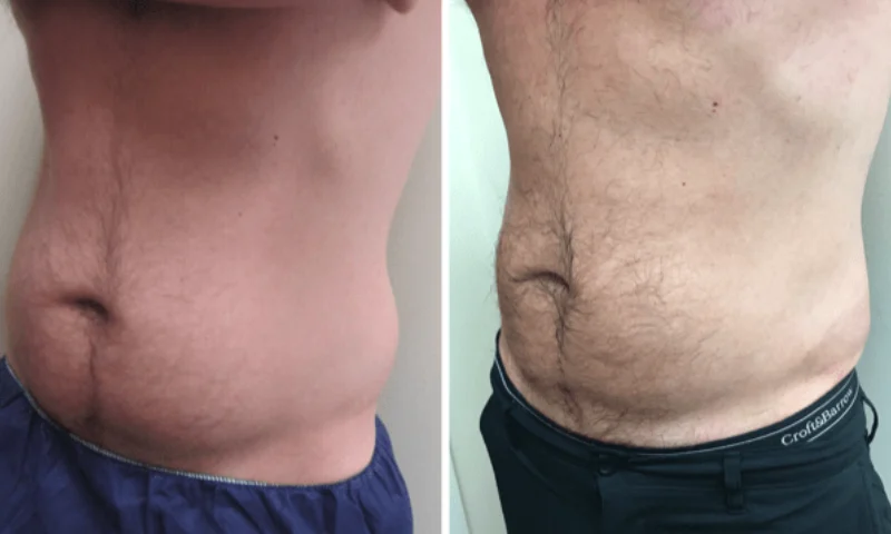 coolsculpting washington dc