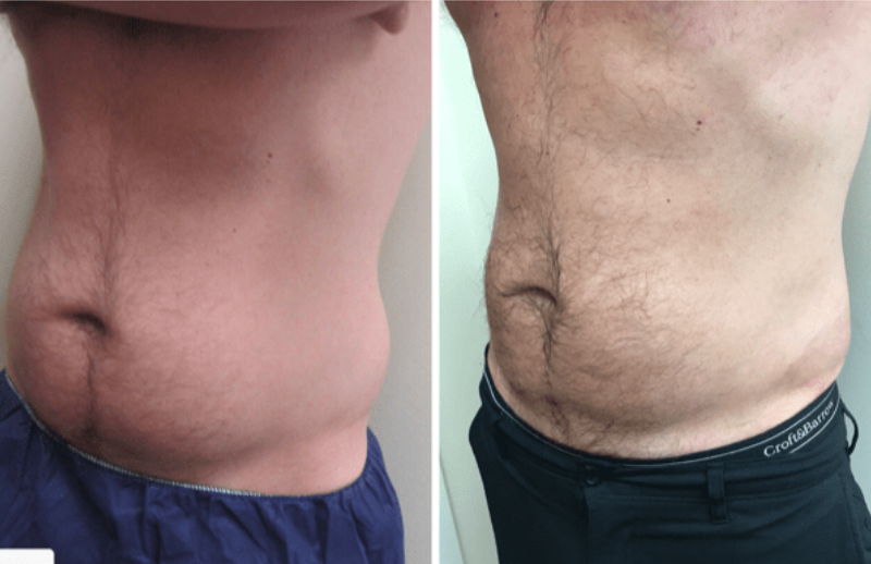 coolsculpting washington dc