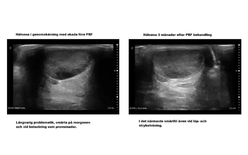 prp behandling stockholm