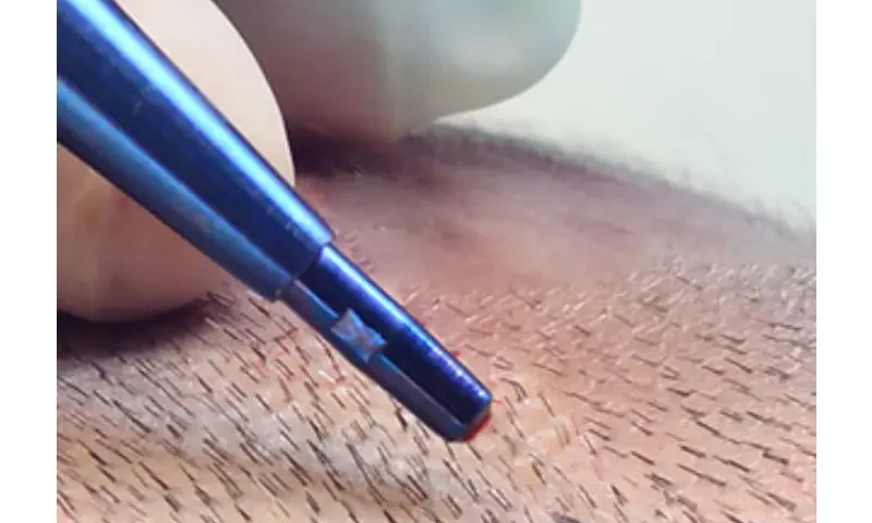 Hair Transplant in Istanbul