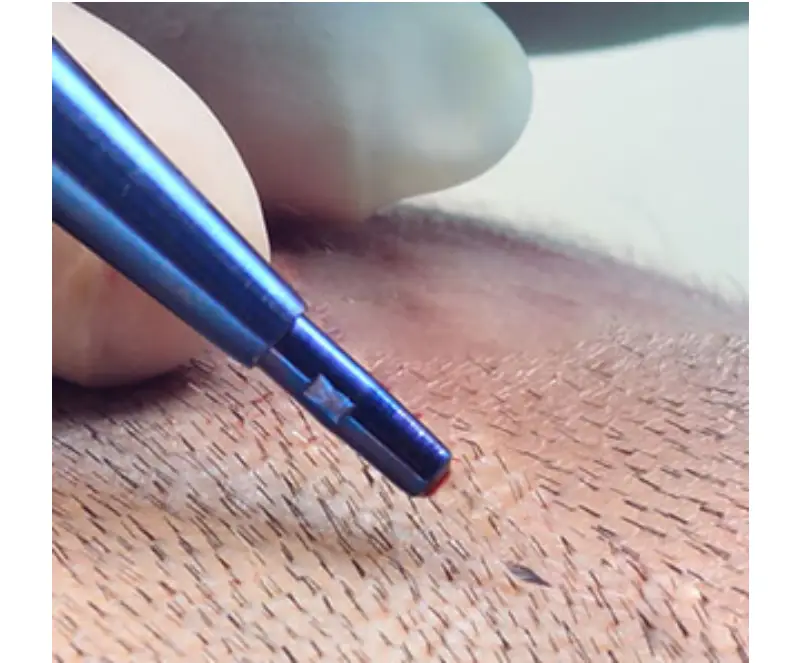 Hair Transplant in Istanbul